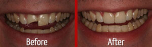 Veneers Ba