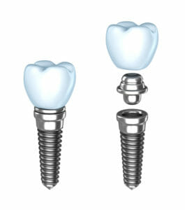 dental implants in Jacksonville