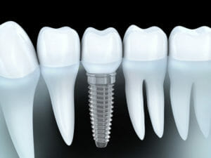 Your Jacksonville implant dentist will replace your missing teeth.
