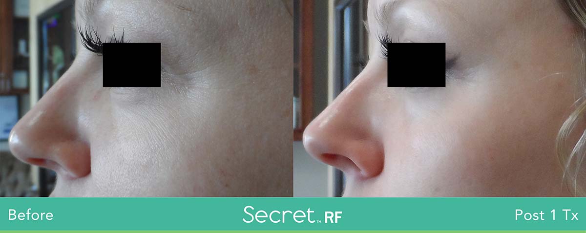 Secret Rf Woman Eyes Treatment 3