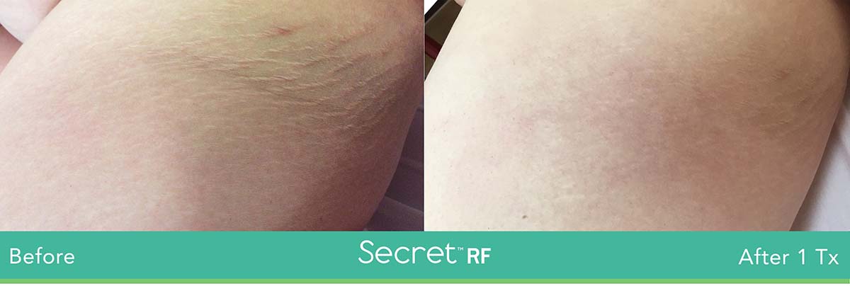 Secret Rf Woman Stretch Marks Treatment