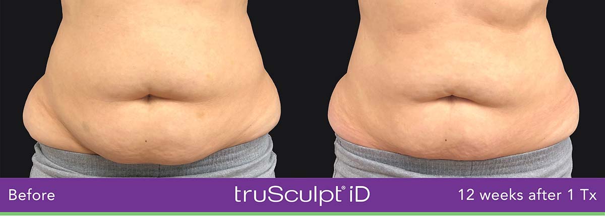Trusculpt Id Woman Belly Before And After 3