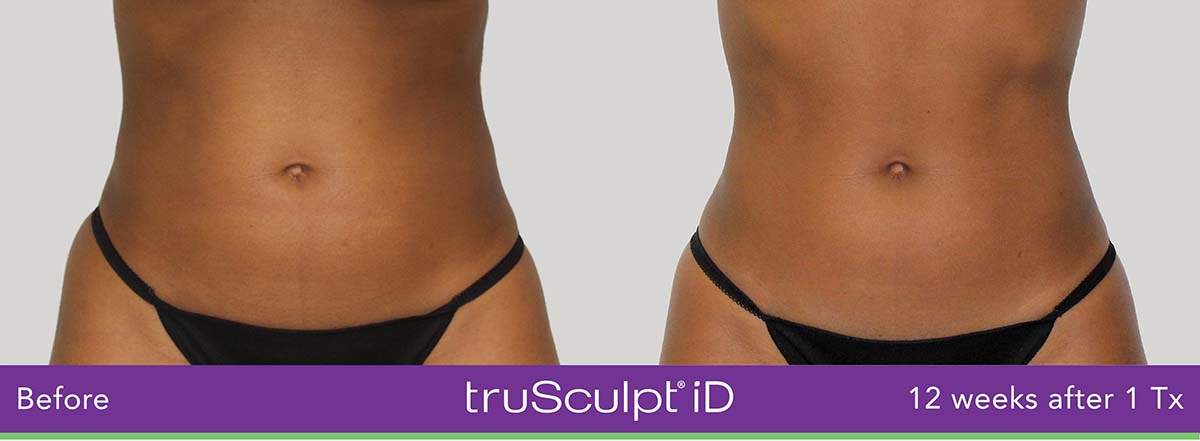 Trusculpt Id Woman Belly Before And After 5