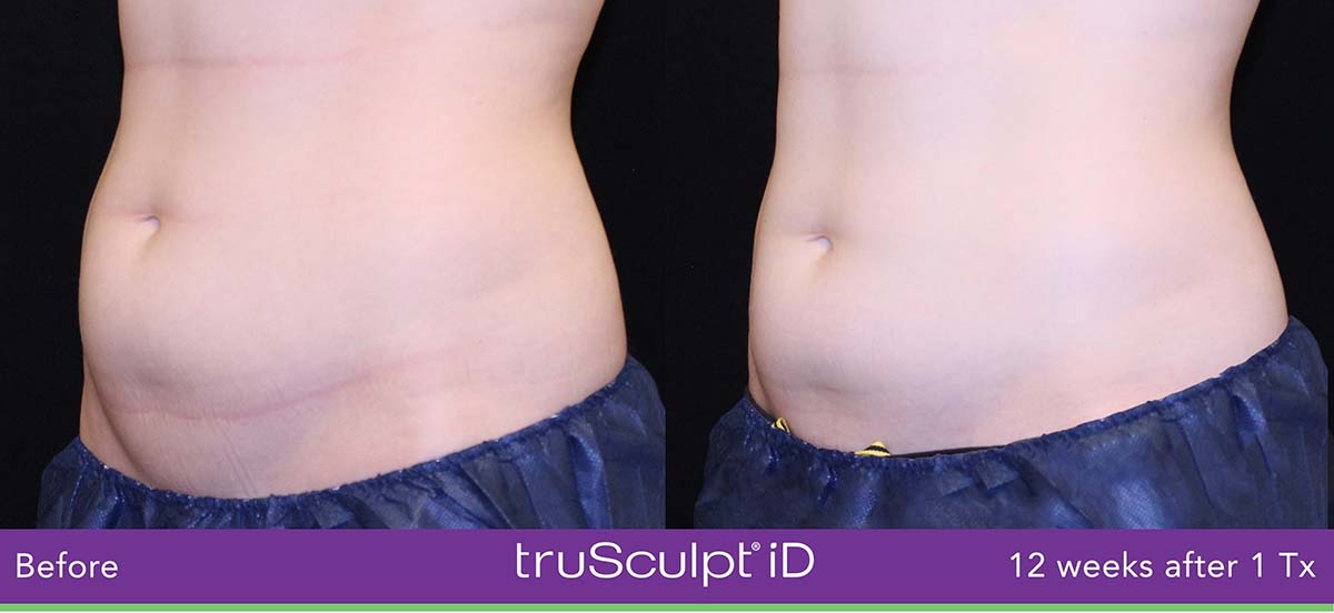 Trusculpt Id Woman Belly Before And After