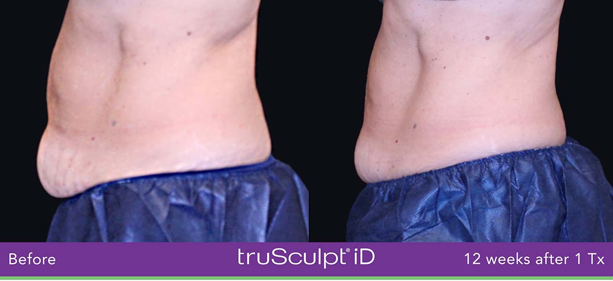 Trusculpt Id Man Belly Before And After 3