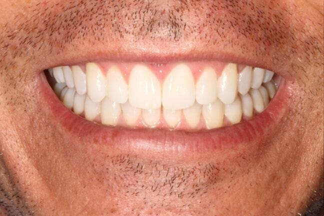After photo of perfectly straight, white teeth