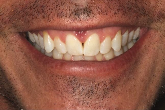 Before photo of discolored, misaligned teeth