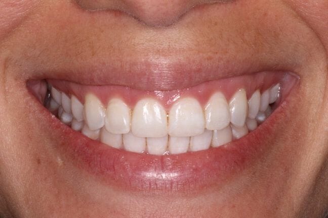 After photo of perfectly straight, white teeth