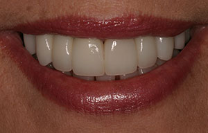 After photo of perfectly straight, white teeth