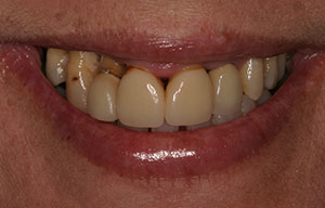 Before photo of discolored, misaligned teeth