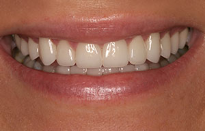 After photo of perfectly straight, white teeth