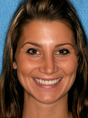 After photo of perfectly straight, white teeth