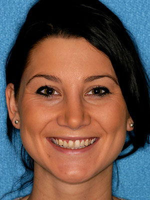 Before photo of discolored, misaligned teeth