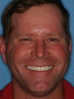 After photo of perfectly straight, white teeth