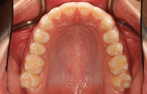 In-mouth after photo of perfectly straight, white teeth