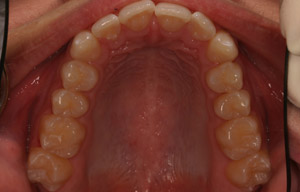 In-mouth before photo of discolored, misaligned teeth