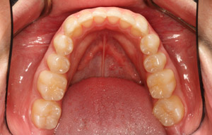 In-mouth after photo of perfectly straight, white teeth