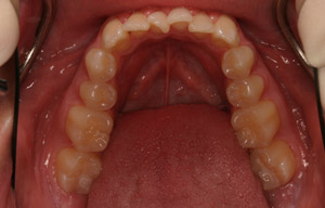In-mouth before photo of discolored, misaligned teeth