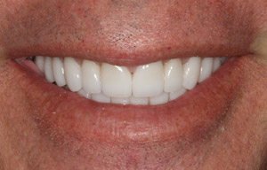 After photo of perfectly straight, white teeth