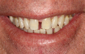 Before photo of discolored, gapped teeth