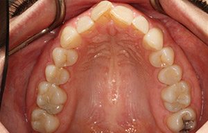 In-mouth before photo of discolored, misaligned teeth