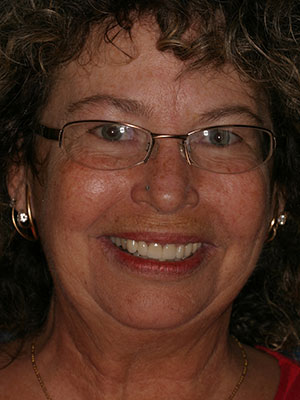 After photo of perfectly straight, white teeth