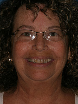 Before photo of discolored, misaligned teeth