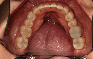 In-mouth after photo of perfectly straight, white teeth