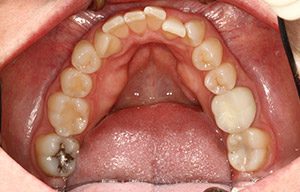 In-mouth before photo of discolored, misaligned teeth