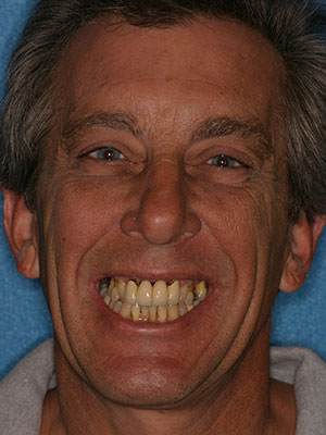 Before photo of discolored, misaligned teeth