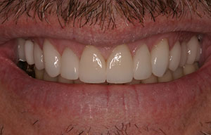After photo of perfectly straight, white teeth