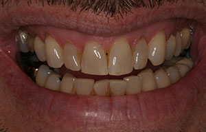 Before photo of discolored, misaligned teeth