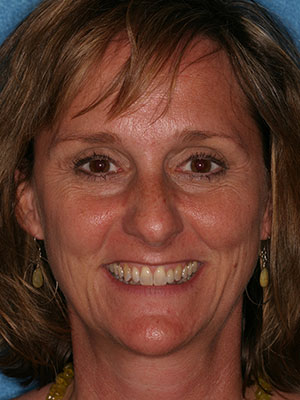 After photo of perfectly straight, white teeth