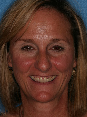 Before photo of discolored, misaligned teeth