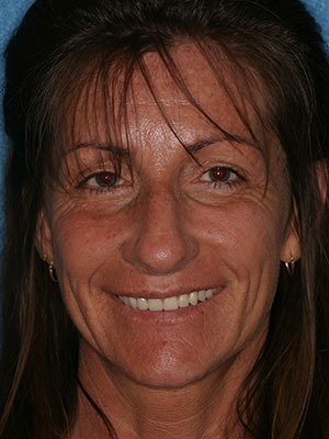 After photo of perfectly straight, white teeth
