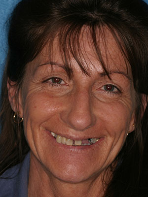 Before photo of discolored, mising tooth, and misaligned teeth