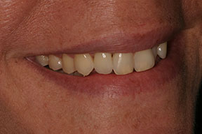 After photo of perfectly straight, white teeth