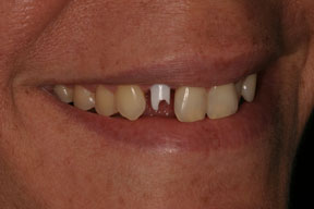 Before photo of discolored, missing tooth smile