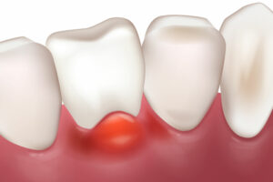 Gum disease