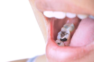 tooth fillings