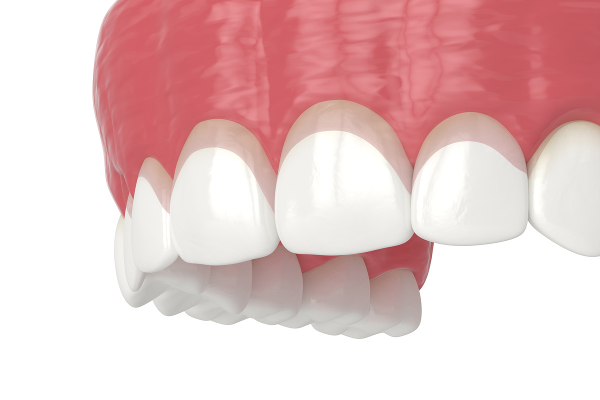 3d render of upper jaw with gummy smile and corrected gum line. Gingivectomy treatment concept.