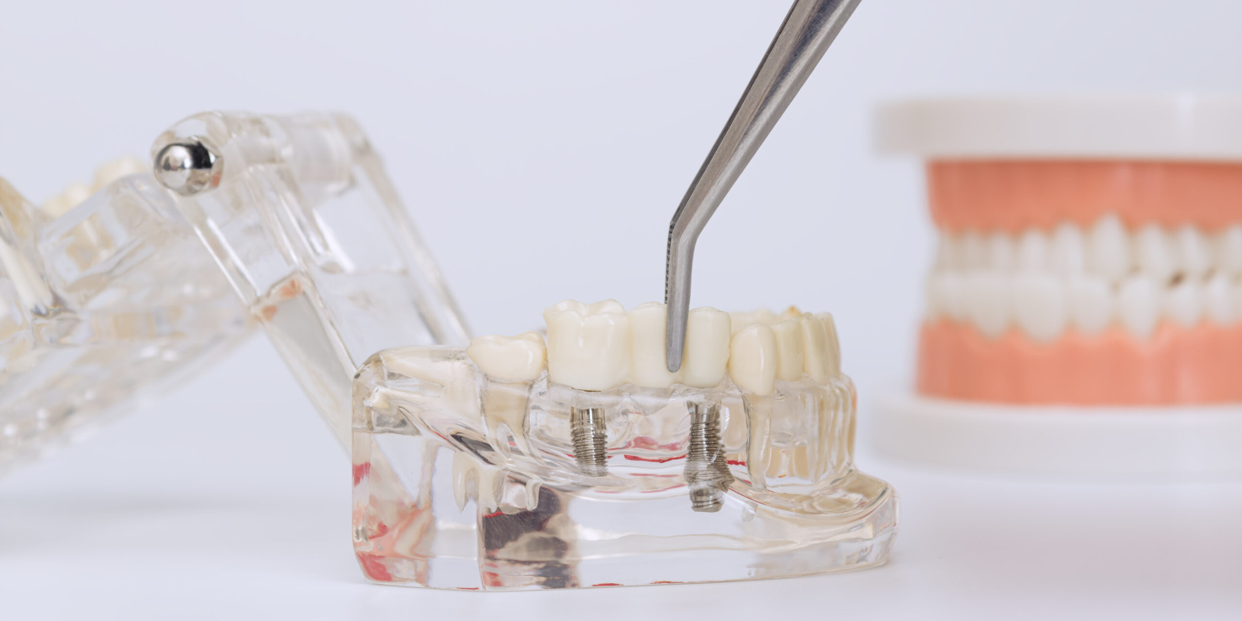Close-up view of tweezers placing a dental crown on a transparent implant model, illustrating dental restoration procedures in detail.