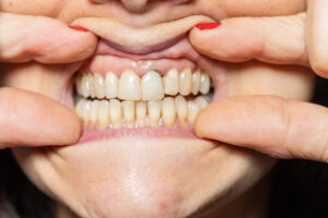 Gum retraction and dental implant, at home