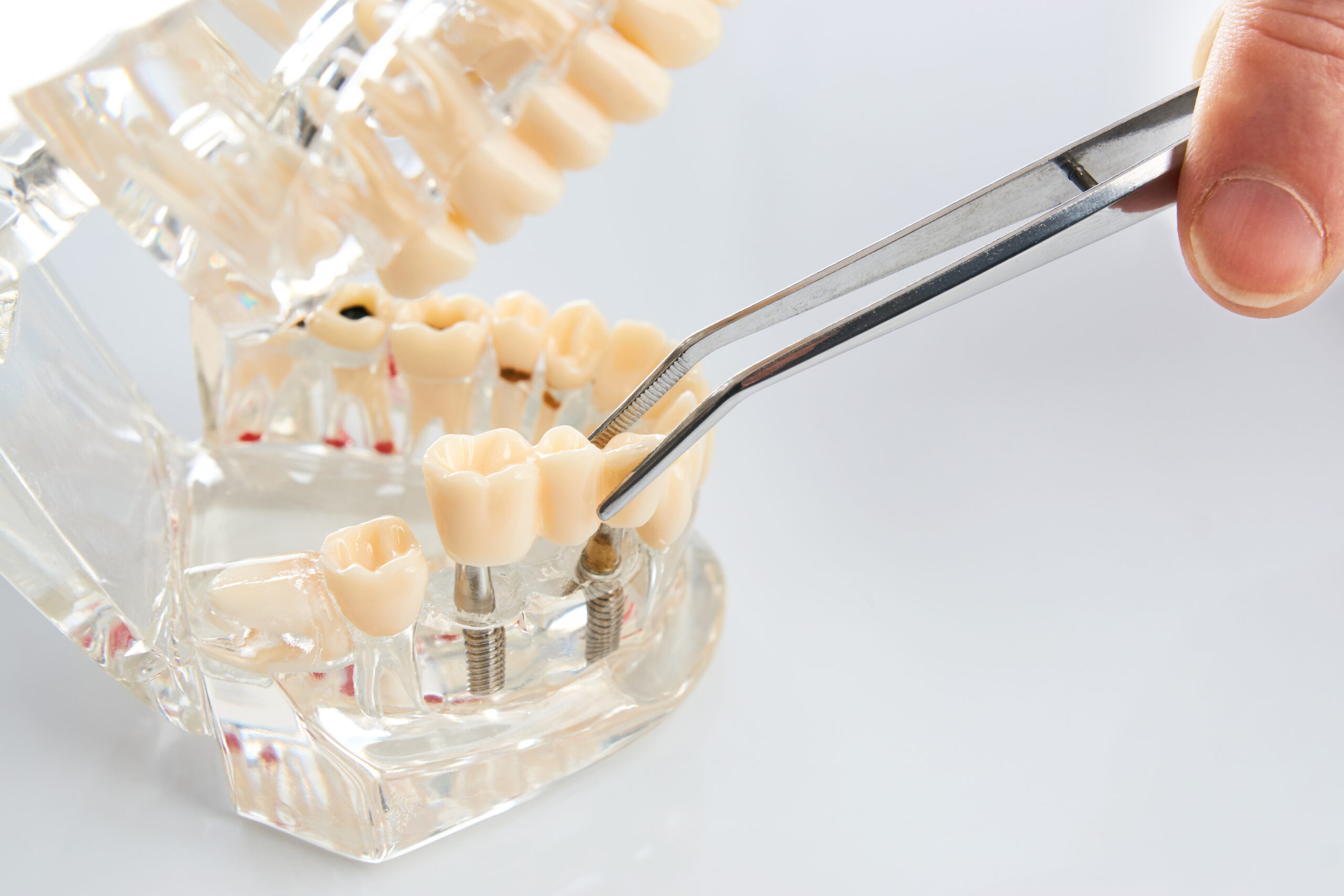 Dental technician placing a fixed dental bridge on implants, illustrating the restoration process